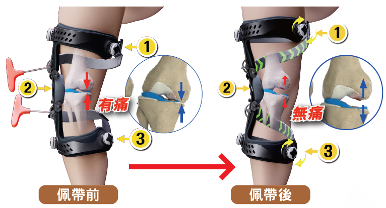 矯形器